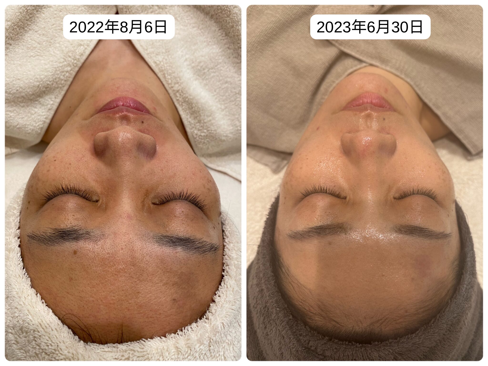 REVI ルヴィ ハーブピーリングBefore＆After | REVI導入ガイド
