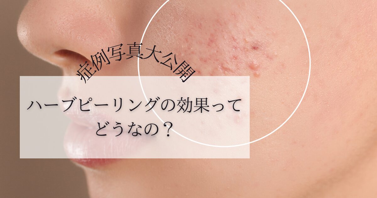 REVI ルヴィ ハーブピーリングビフォー＆アフター写真